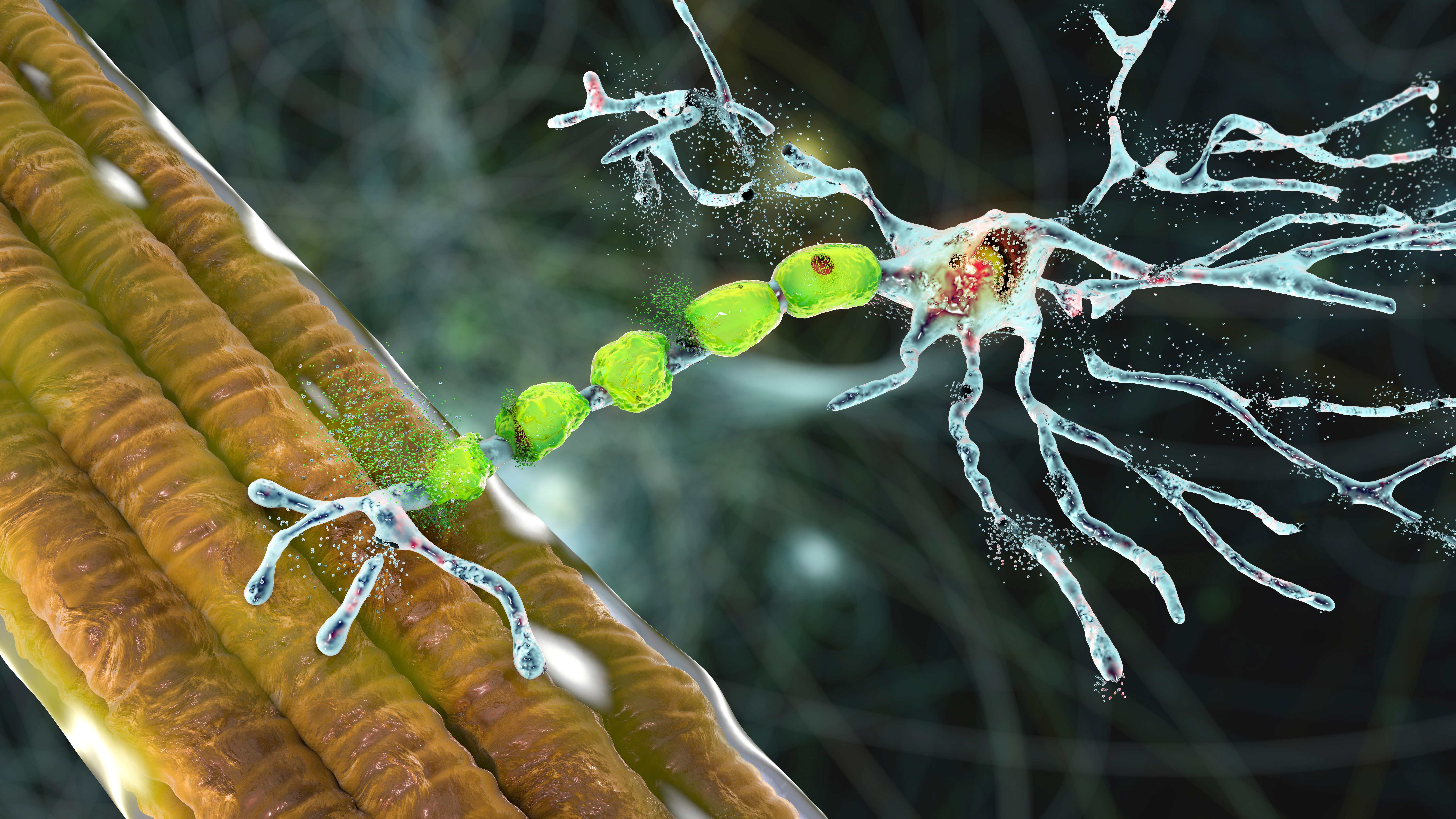 Degradación de neuronas motoras, ilustración 3D conceptual