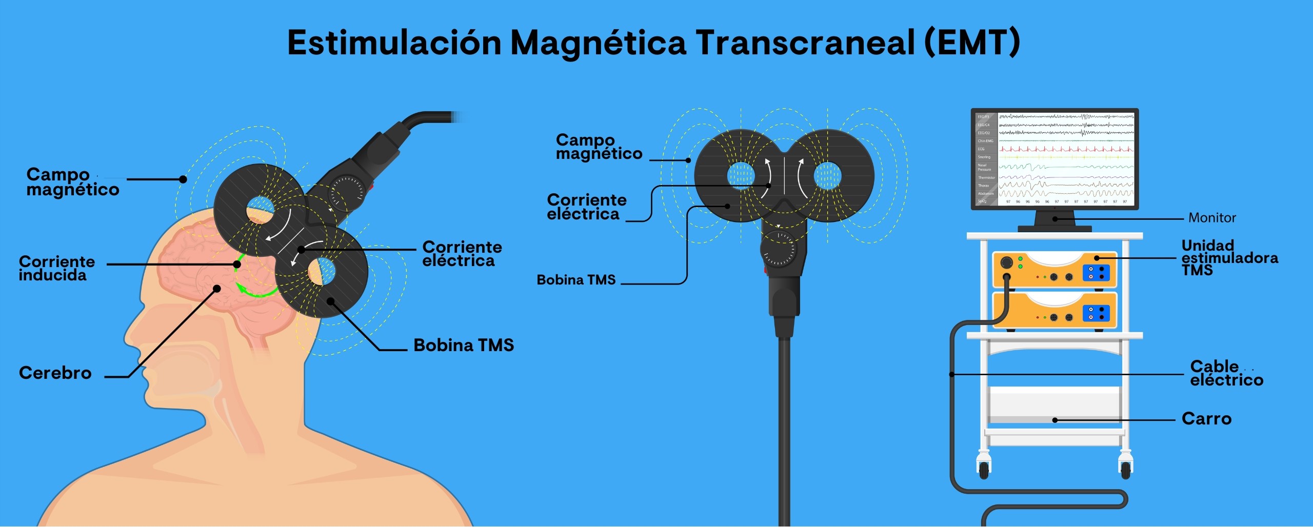 Esquema de un dispositivo de estimulación magnética transcraneal (EMT)